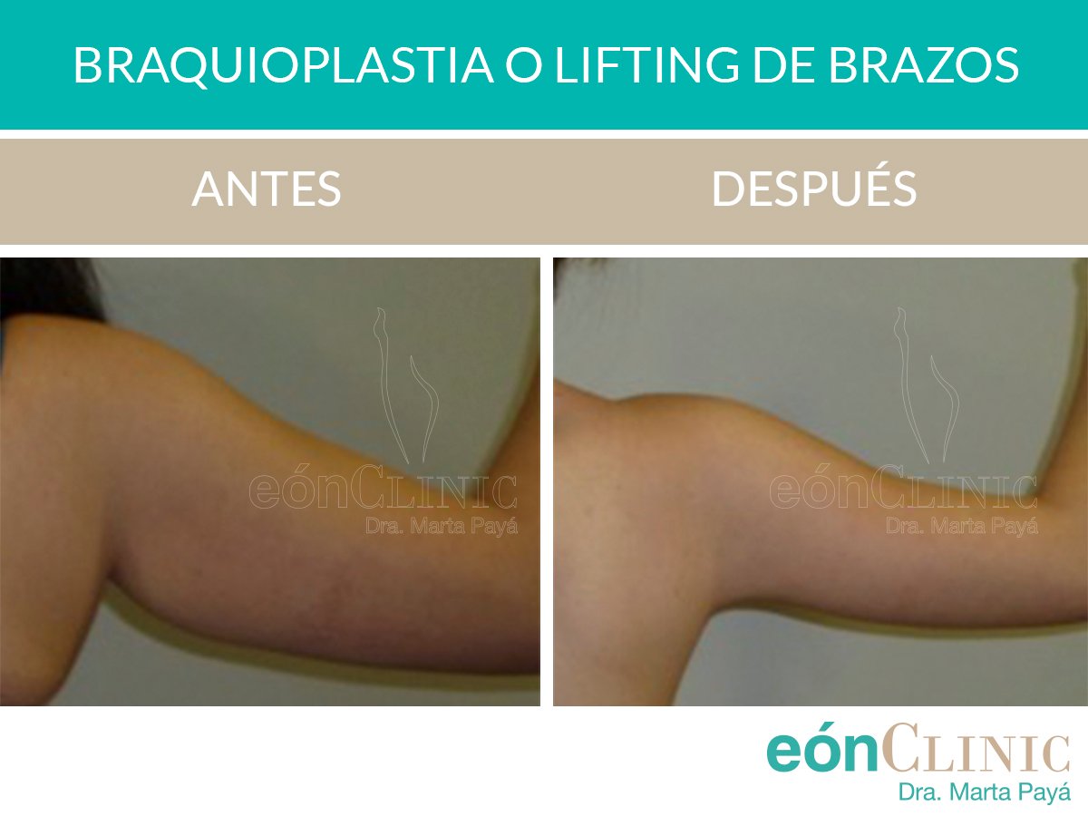 gusto paraguas Accidentalmente Lifting de brazos (Braquioplastia) | EónClinic Dra Marta Payá