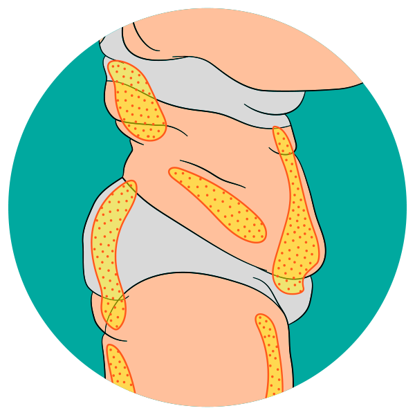 Abdominoplastia especial con liposucción asociada