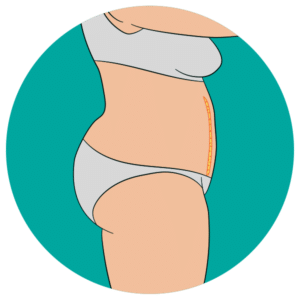 Miniabdominoplastia