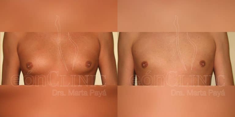 Liposucción EónClinic Doctora Marta Payá Mallorca