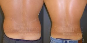 Liposucción EónClinic Doctora Marta Payá Mallorca