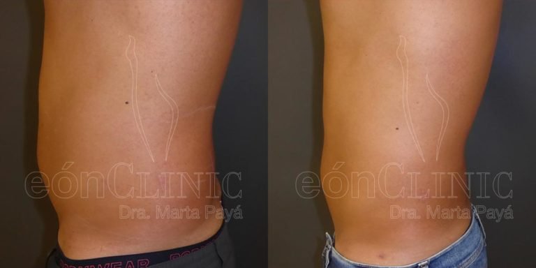 Liposucción EónClinic Doctora Marta Payá Mallorca
