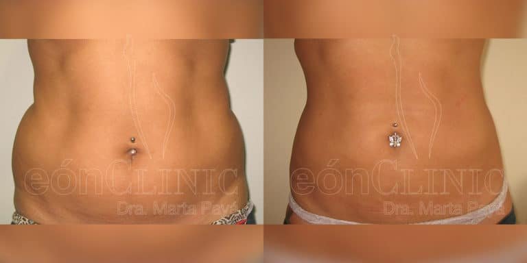 Liposucción EónClinic Doctora Marta Payá Mallorca