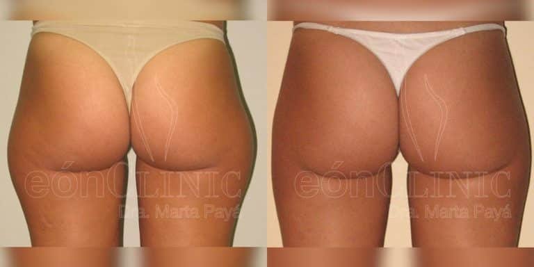 Liposucción EónClinic Doctora Marta Payá Mallorca