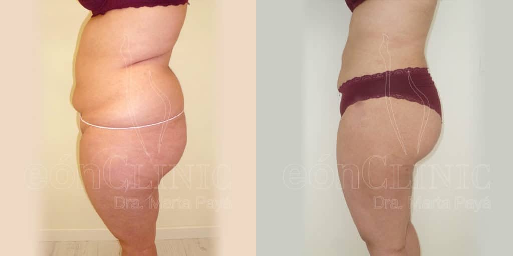 Liposucción EónClinic Doctora Marta Payá Mallorca