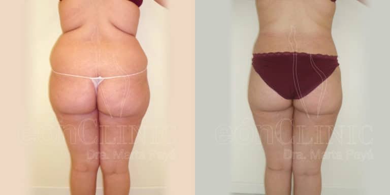 Liposucción EónClinic Doctora Marta Payá Mallorca