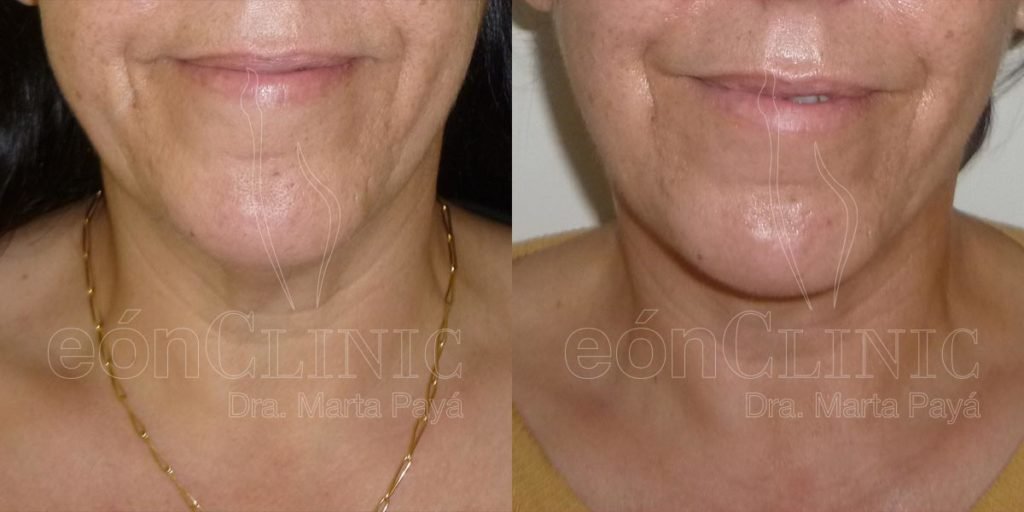 Liposucción EónClinic Doctora Marta Payá Mallorca