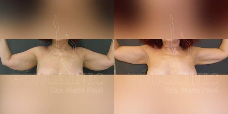 Liposucción EónClinic Doctora Marta Payá Mallorca