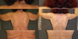 Liposucción EónClinic Doctora Marta Payá Mallorca