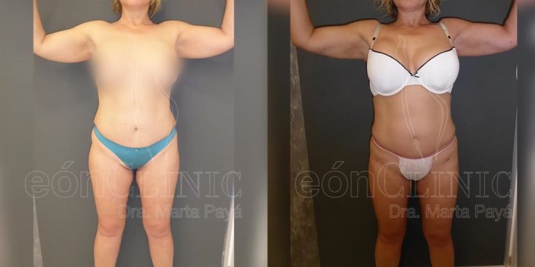 Liposucción EónClinic Doctora Marta Payá Mallorca