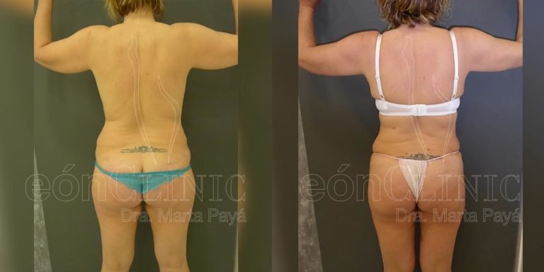 Liposucción EónClinic Doctora Marta Payá Mallorca