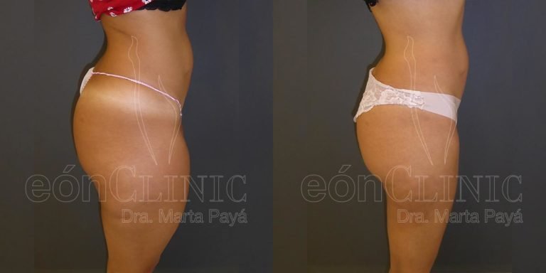 Liposucción EónClinic Doctora Marta Payá Mallorca