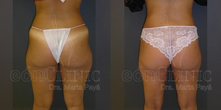Liposucción EónClinic Doctora Marta Payá Mallorca
