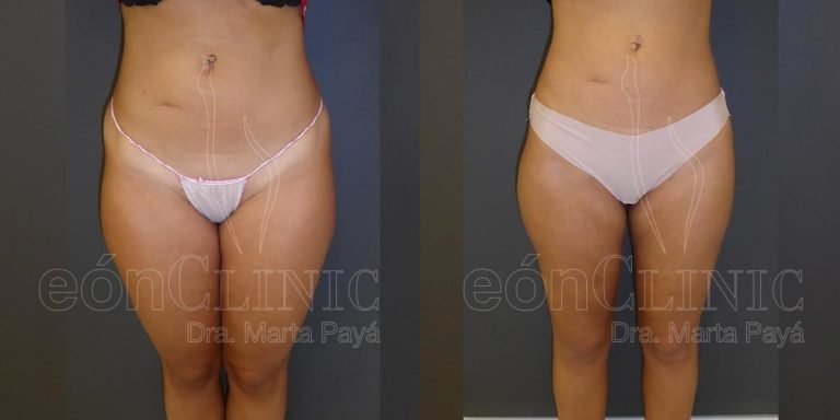Liposucción EónClinic Doctora Marta Payá Mallorca