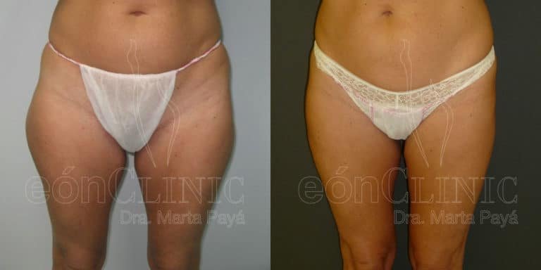 Marcaje para lipoescultura Dra. Marta Payá Eónclinic