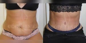 Abdominoplastia Eónclinic