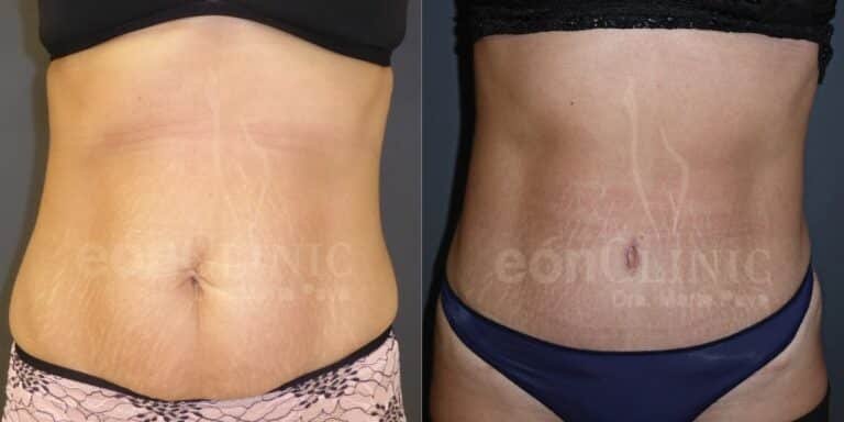 Abdominoplastia Eónclinic