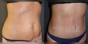 Abdominoplastia Eónclinic