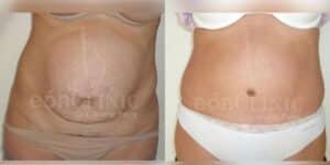 Abdominoplastia Eónclinic