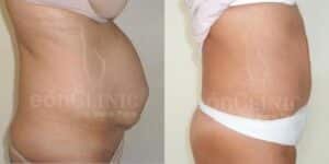 Abdominoplastia Eónclinic