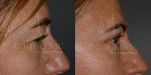 Blefaroplastia superior e inferior