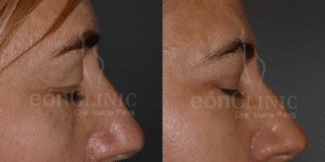 Blefaroplastia superior e inferior