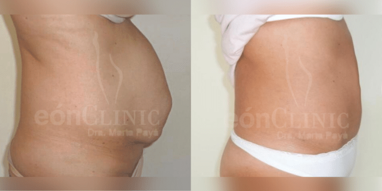 Abdominoplastia Eónclinic