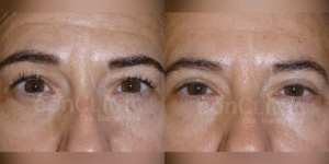 Blefaroplastia Eonclinic 01