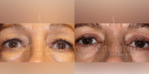 Blefaroplastia inferior Eonclinic 01 (1)