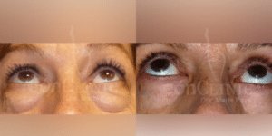 Blefaroplastia inferior Eonclinic 01 (2)