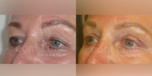 Blefaroplastia superior Eonclinic 03 (1)