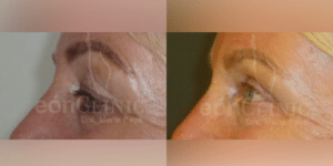 Blefaroplastia superior Eonclinic 03 (2)