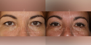 Blefaroplastia superior Eonclinic 04 (2)