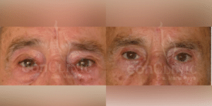 Blefaroplastia superior e inferior Eonclinic 03 (1)