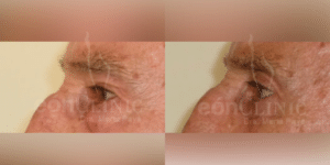 Blefaroplastia superior e inferior Eonclinic 03 (2)