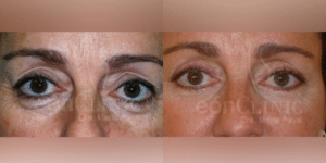 Blefaroplastia superior e inferior Eonclinic 04 (1)