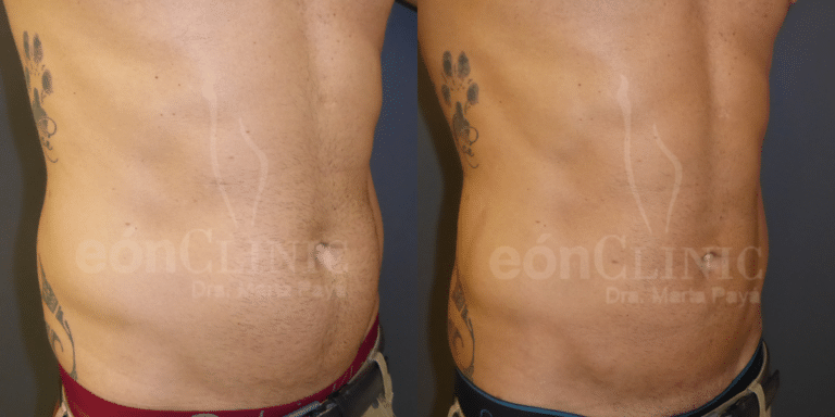 Lipolaser zona abdominal y flancos Eonclinic (1)