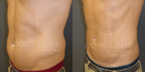 Lipolaser zona abdominal y flancos Eonclinic (2)