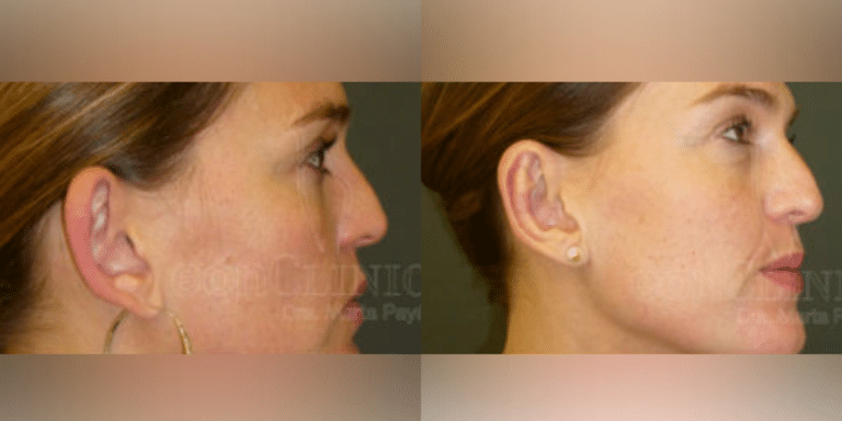 Otoplastia Doctora Marta Paya (2)