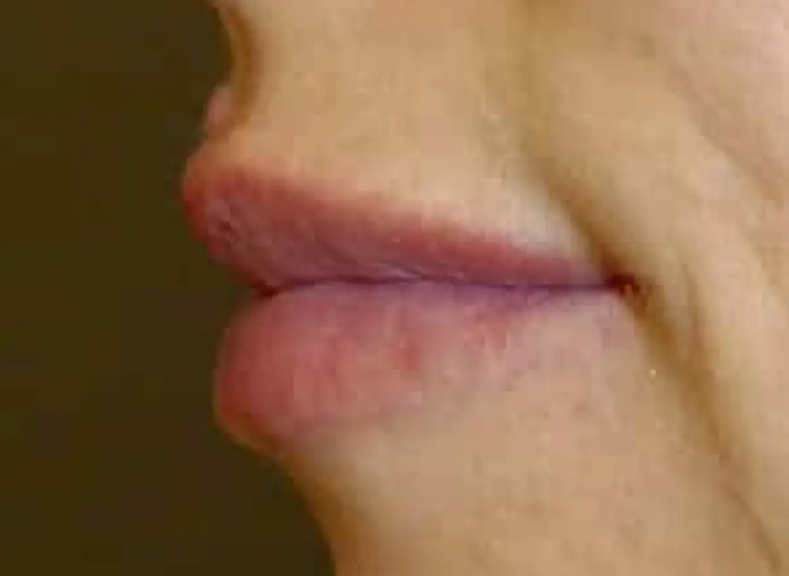 labios-antes-1142x834