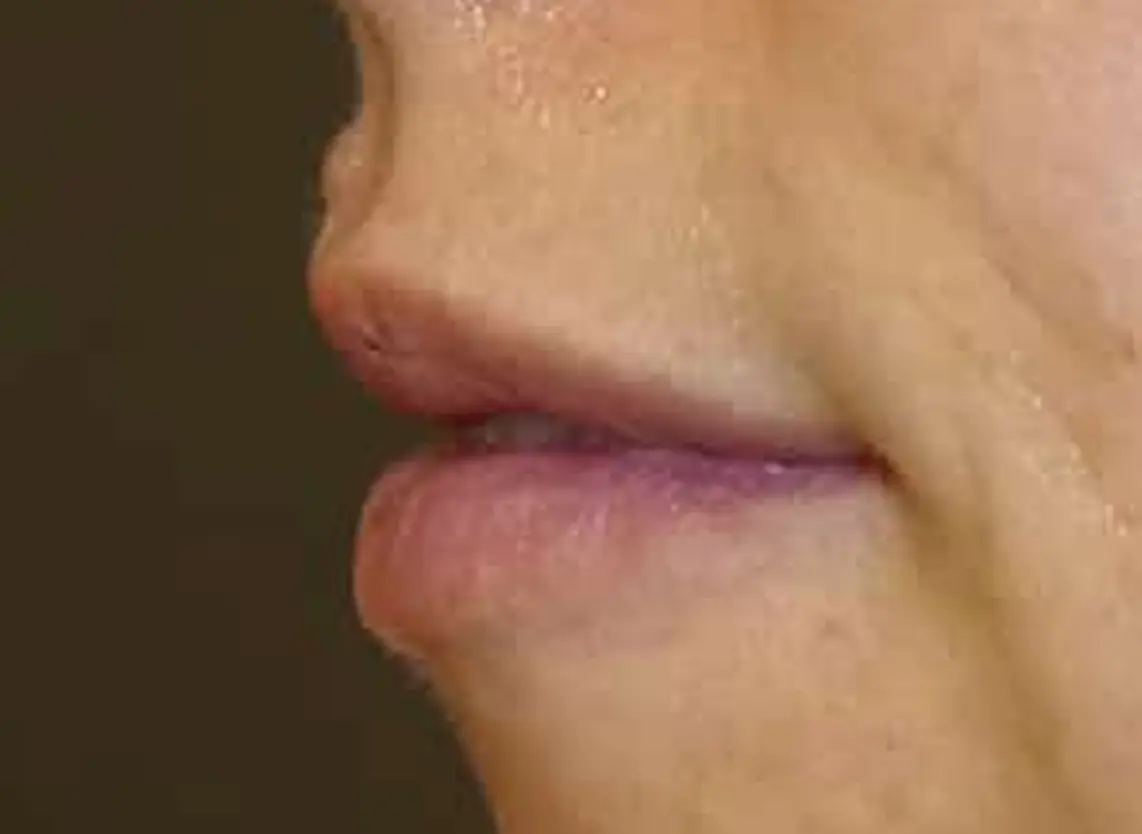 labios-después-1142x834